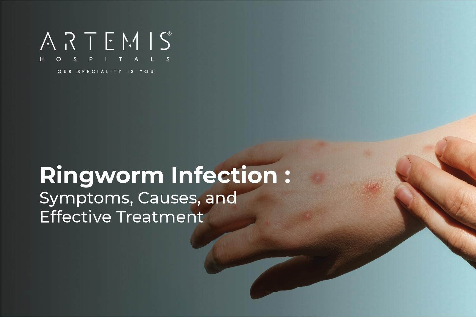 Ringworm Symptoms
